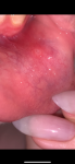 Белое пятно на слизистой нижней губы фото 1