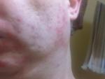 Аллергия после бритья и дерматит фото 2