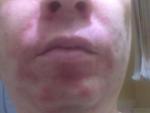 Аллергия после бритья и дерматит фото 1