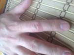 Болячки на пальцах рук фото 1