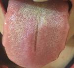 Белый налёт на языке с кашлем и болью в горле фото 1