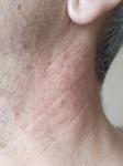 Раздражение кожи на шее и груди после бритья фото 2