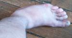 Травма голеностопного сустава фото 1