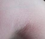 Сухость шелушение потрескавшаяся кожа на плече ближе к подмышечной впадине фото 2