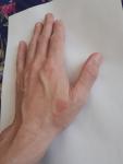 Красное пятно у основания большого пальца левой руки фото 1