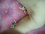 Аллергия, потница или цветение кожи фото 2