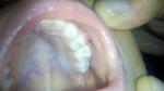 Кистообразная шишка на десне у ребенка фото 4