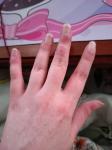 Красные круглые болячки на пальцах рук фото 2