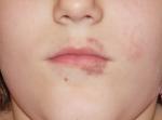 У ребенка 8 лет красные пятна вокруг губ фото 1