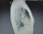 Рентген органов грудной клетки фото 2
