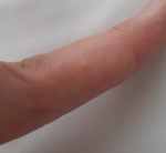 Концентрация сыпи на кистях рук и меньше по телу фото 2