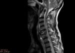 Сможет ли встать на ноги после травмы спинного мозга (МРТ) фото 2