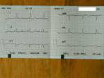 Расшифровка кардиограммы после болей фото 2