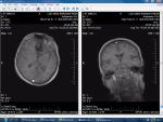 Заболевание сосудов головного мозга фото 2
