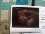 Возможна ли беременность при такой фолликулометрии фото 2