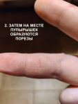 Распространяющаяся инфекция с очагом на пальце руки фото 2