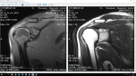 Расшифровка МРТ левого плечевого сустава фото 2