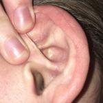 Новообразование на хряще ушной раковины фото 2