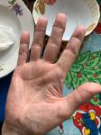 Жжение и микротрещины пальцев рук фото 2