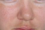 Как избавиться от купероза на лице? фото 1