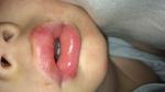 Болячки на губах и языке у ребёнка фото 1