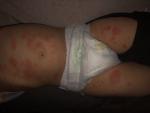 Сильная аллергия у ребенка, помогите пожалуйста! фото 2