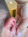 Кожные заболевания на ушной раковине фото 1