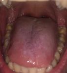Лейкоплакия полости рта фото 2