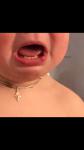 Шишка на губе у ребёнка фото 1