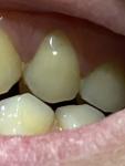 Боль в пришеичной области зуба фото 1
