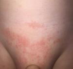 Аллергия или контактный дерматит у ребёнка фото 5