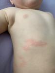 Аллергия у ребёнка в виде красных полос фото 3