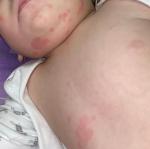Аллергия или нет у ребенка фото 2