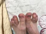 Пупырышки на больших пальцах ног около ногтей фото 4