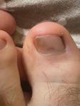 Светло коричневое пятно на ногте большого пальца ноги фото 1