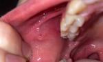 Красное горло и воспаление слизистой фото 3