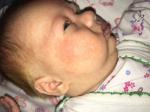 Аллергия и акне у месячного ребёнка фото 4