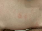 Появились шершавые пятна на спине дочери после курса массажа фото 1