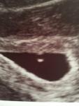 Эмбрион в 5,5 недель на УЗИ фото 1