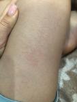 Красное пятно на ноге у ребёнка 8 лет фото 1
