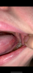 Болит горло, язык, воспалённые сосочки фото 2