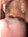 Белые пятна во рту (стоматит?) фото 4