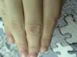 Огрубевшая кожа на сгибе пальца и трещинки фото 2