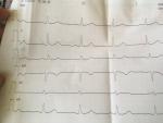 Помогите пожалуйста расшифровать кардиограмму фото 2