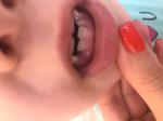 У ребёнка лезет кривой зуб фото 2