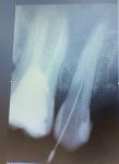 Болит зуб с временной пломбой при нажатии фото 1
