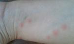 Сыпь в виде комариных укусов фото 3