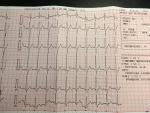 На ЭКГ ишемия миокарда V1 фото 3