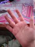 Красные круглые болячки на пальцах рук фото 3