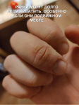 Распространяющаяся инфекция с очагом на пальце руки фото 3